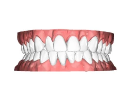 Crossbite