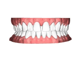Diastema