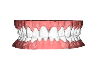 Overbite